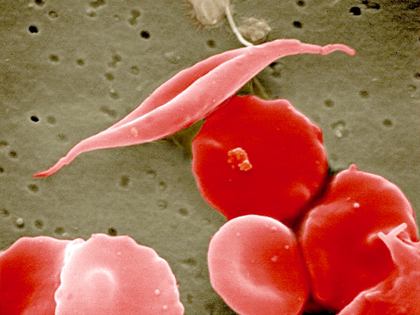 sickle cell among normal, healthy cells